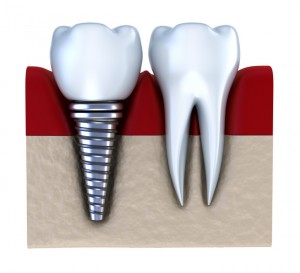 dental implants Anchorage