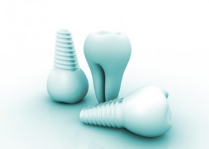 dental implants Anchorage