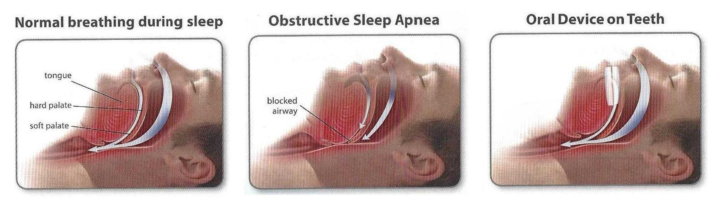 Sleep apnea process illustrator